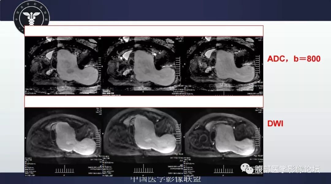 【病例】盆腔低级别去分化脂肪肉瘤1例CT及MR影像