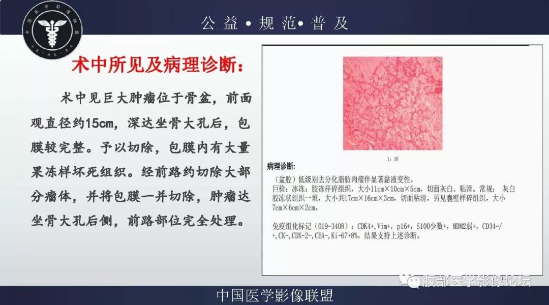 【病例】盆腔低级别去分化脂肪肉瘤1例CT及MR影像