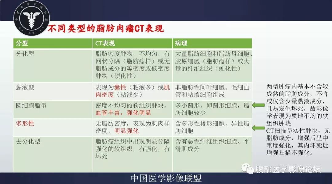 【病例】盆腔低级别去分化脂肪肉瘤1例CT及MR影像