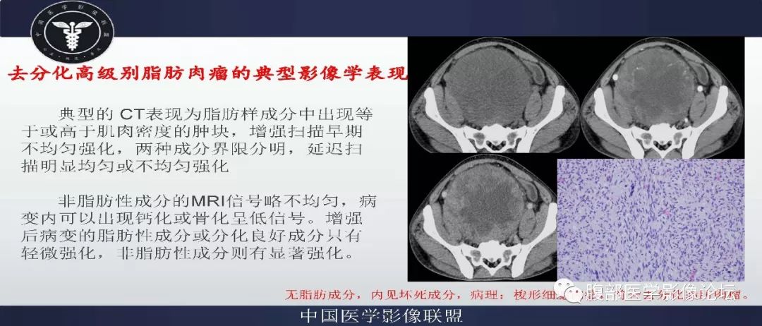 【病例】盆腔低级别去分化脂肪肉瘤1例CT及MR影像