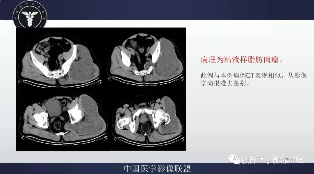 【病例】盆腔低级别去分化脂肪肉瘤1例CT及MR影像
