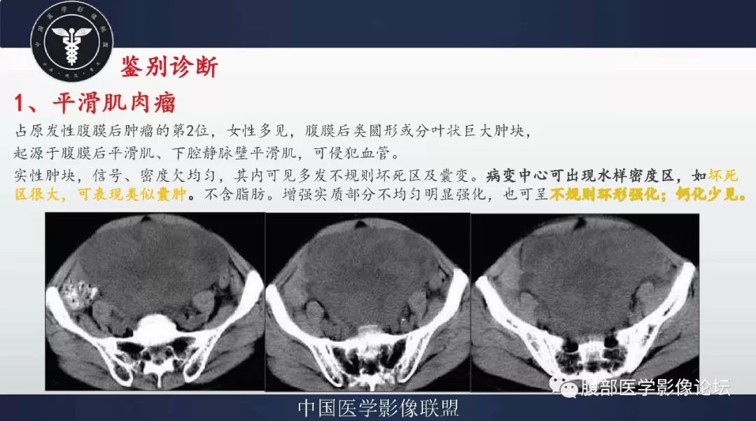 【病例】盆腔低级别去分化脂肪肉瘤1例CT及MR影像