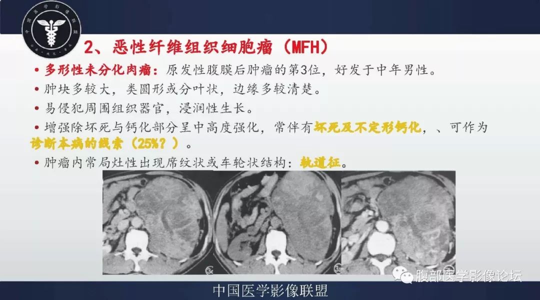 【病例】盆腔低级别去分化脂肪肉瘤1例CT及MR影像