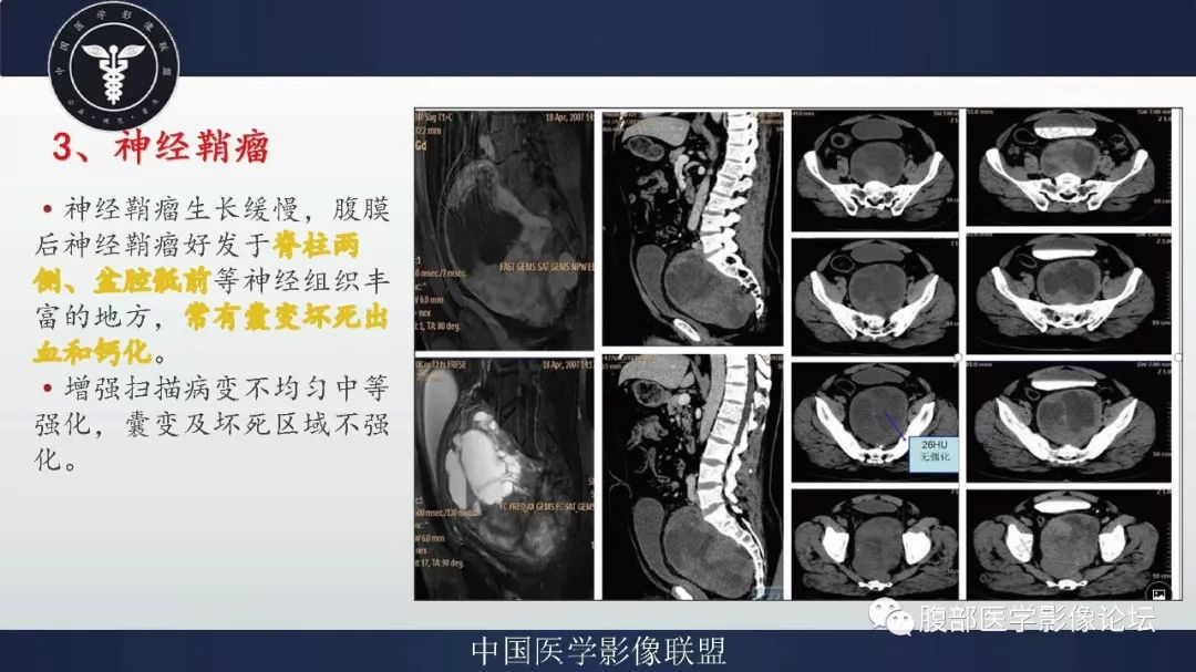 【病例】盆腔低级别去分化脂肪肉瘤1例CT及MR影像