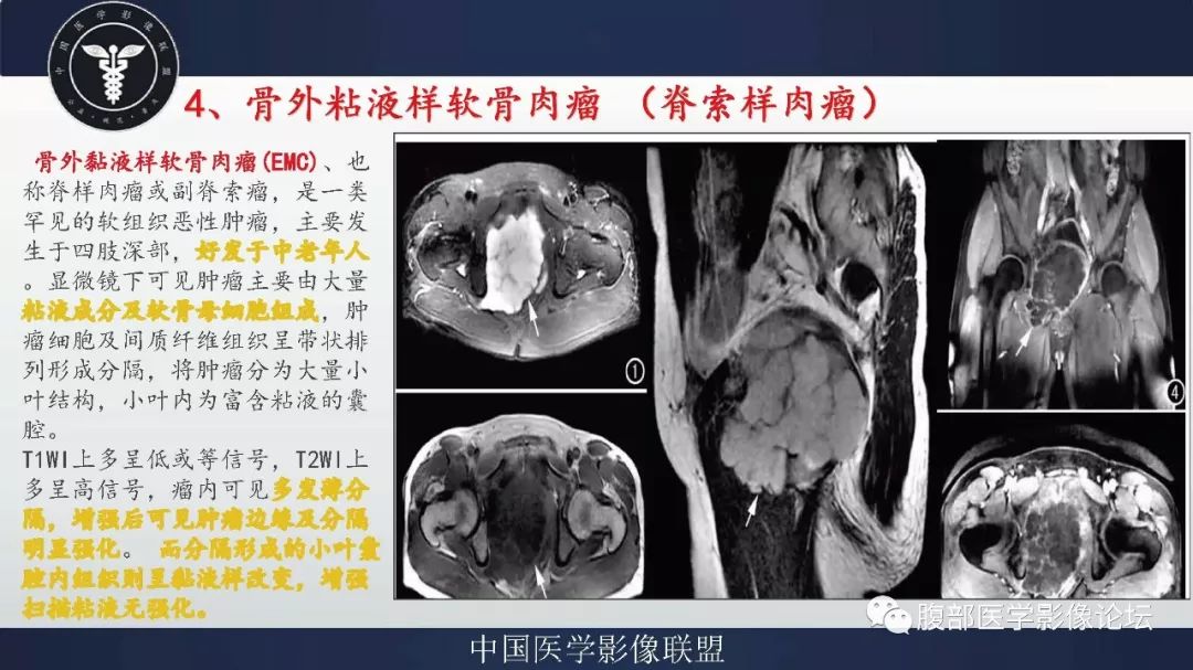 【病例】盆腔低级别去分化脂肪肉瘤1例CT及MR影像