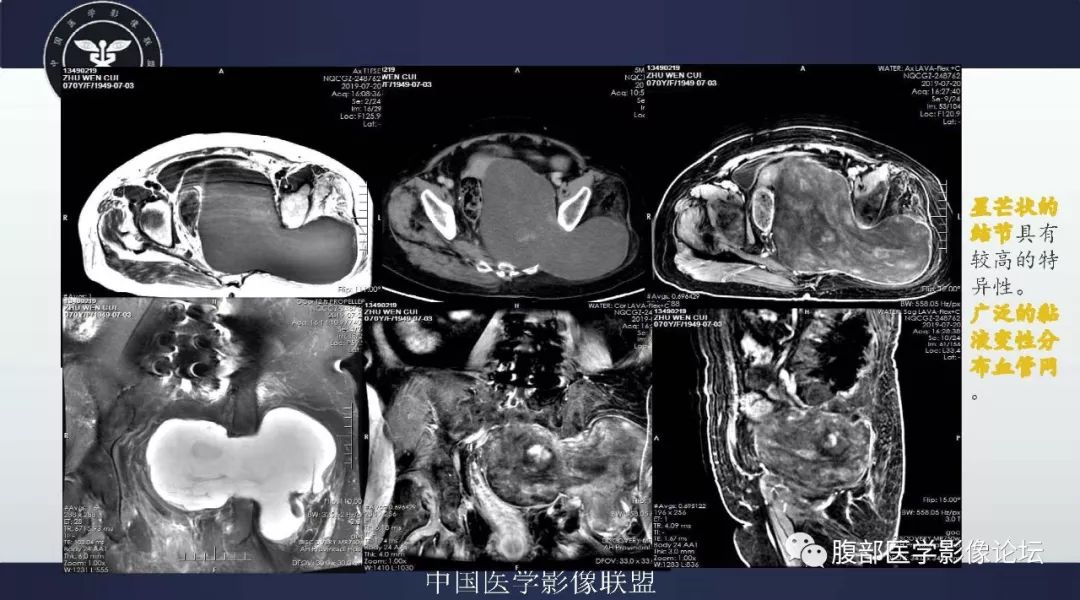 【病例】盆腔低级别去分化脂肪肉瘤1例CT及MR影像