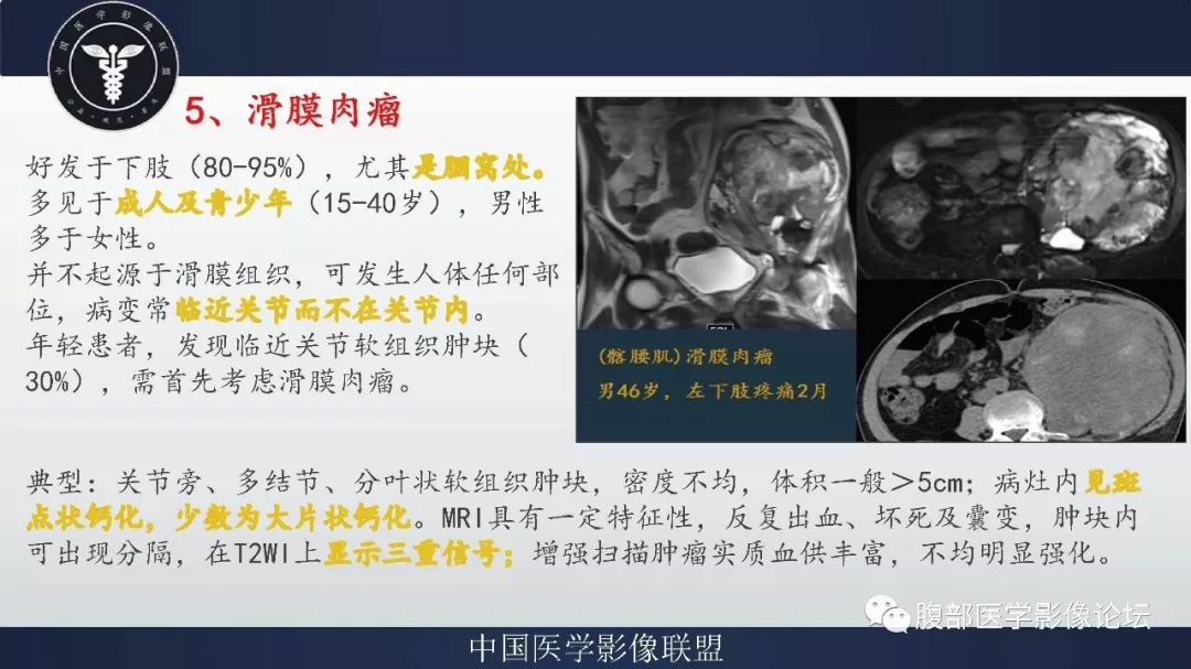 【病例】盆腔低级别去分化脂肪肉瘤1例CT及MR影像