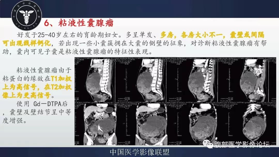 【病例】盆腔低级别去分化脂肪肉瘤1例CT及MR影像