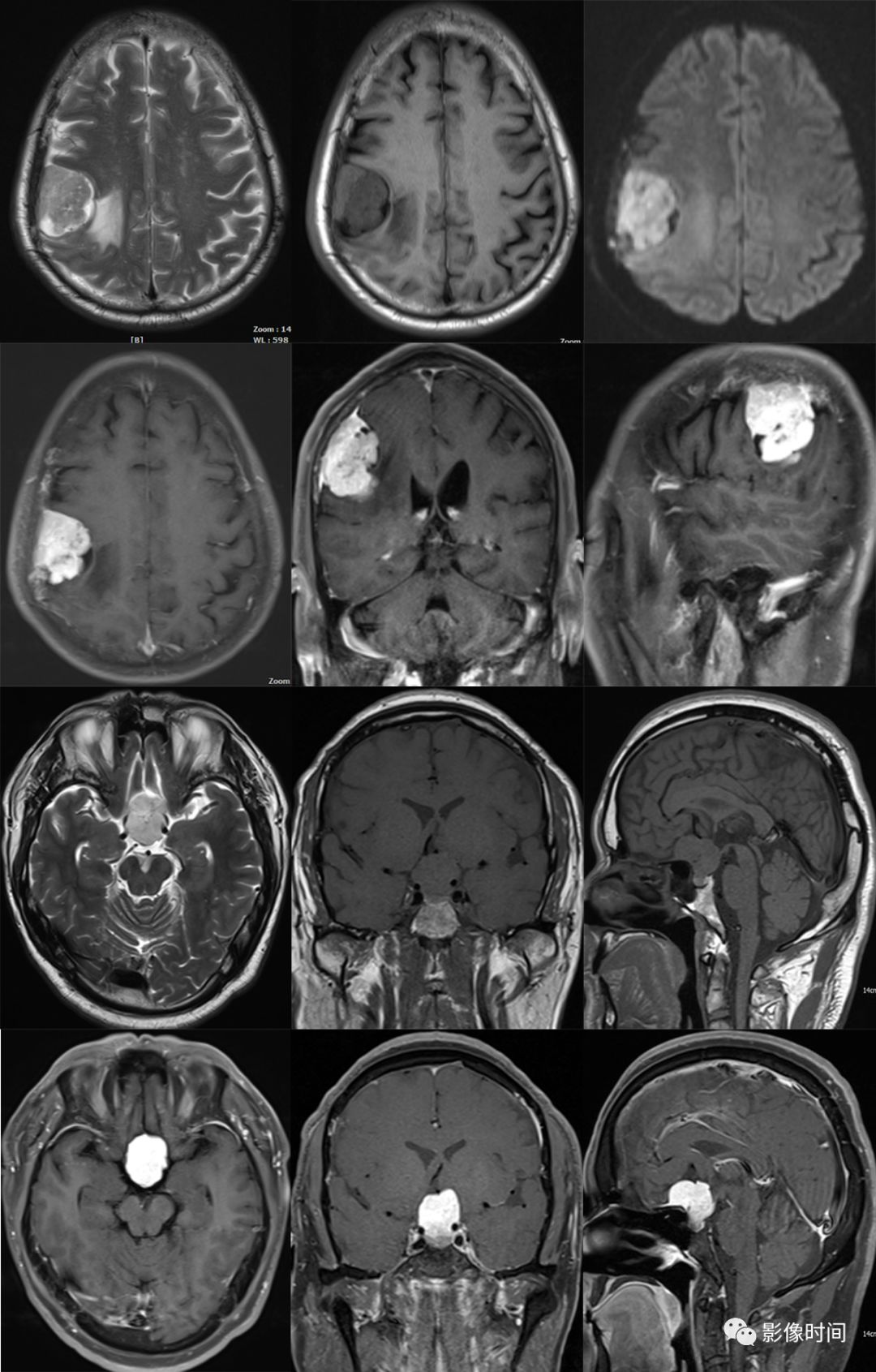 颅内全瘤性强化占位性病变的 MRI 表现 颅内全瘤性强化占位性病变的 MRI 表现