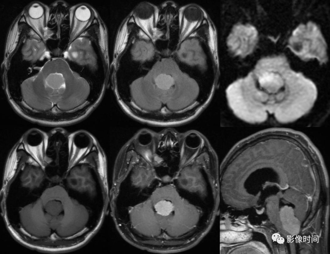 颅内全瘤性强化占位性病变的 MRI 表现 颅内全瘤性强化占位性病变的 MRI 表现