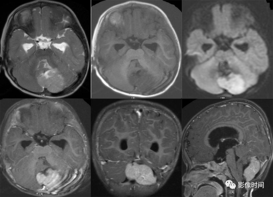 颅内全瘤性强化占位性病变的 MRI 表现 颅内全瘤性强化占位性病变的 MRI 表现