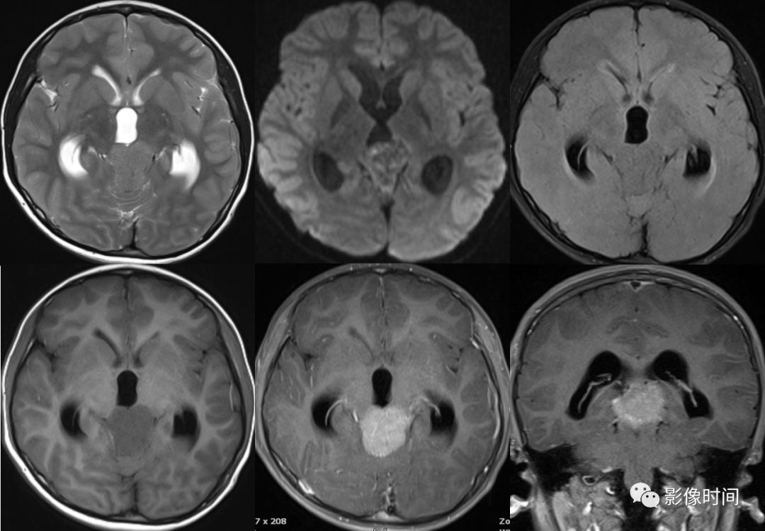 颅内全瘤性强化占位性病变的 MRI 表现 颅内全瘤性强化占位性病变的 MRI 表现