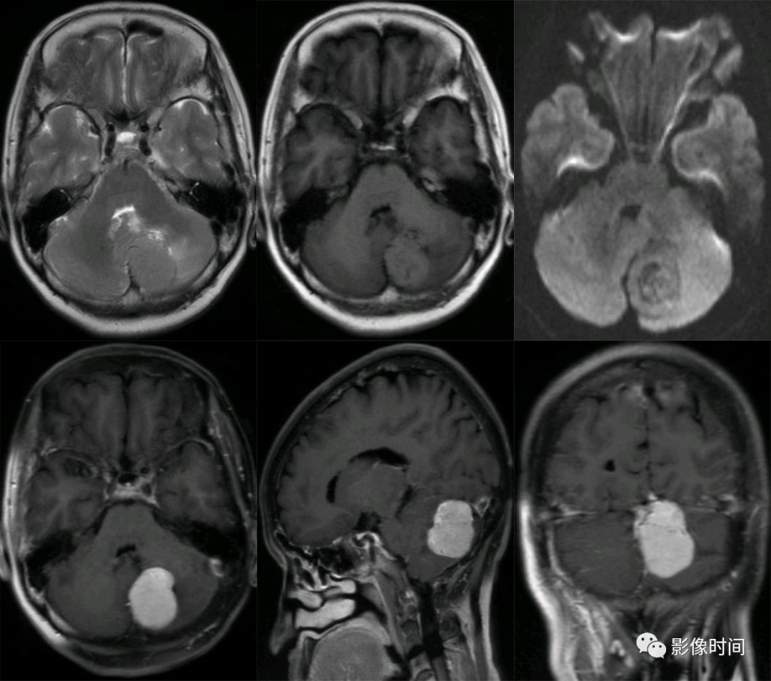 颅内全瘤性强化占位性病变的 MRI 表现 颅内全瘤性强化占位性病变的 MRI 表现