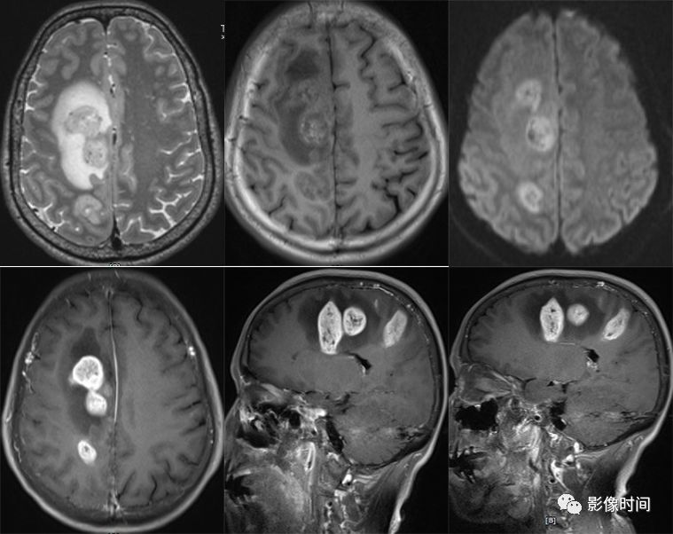 颅内全瘤性强化占位性病变的 MRI 表现 颅内全瘤性强化占位性病变的 MRI 表现