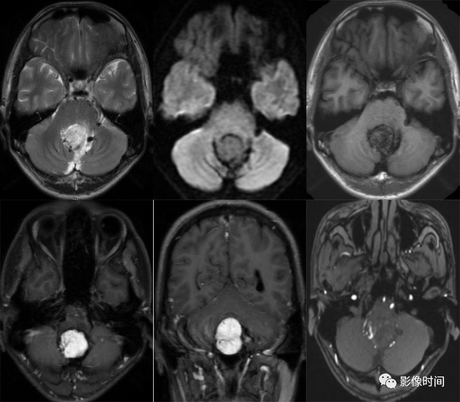 颅内全瘤性强化占位性病变的 MRI 表现 颅内全瘤性强化占位性病变的 MRI 表现