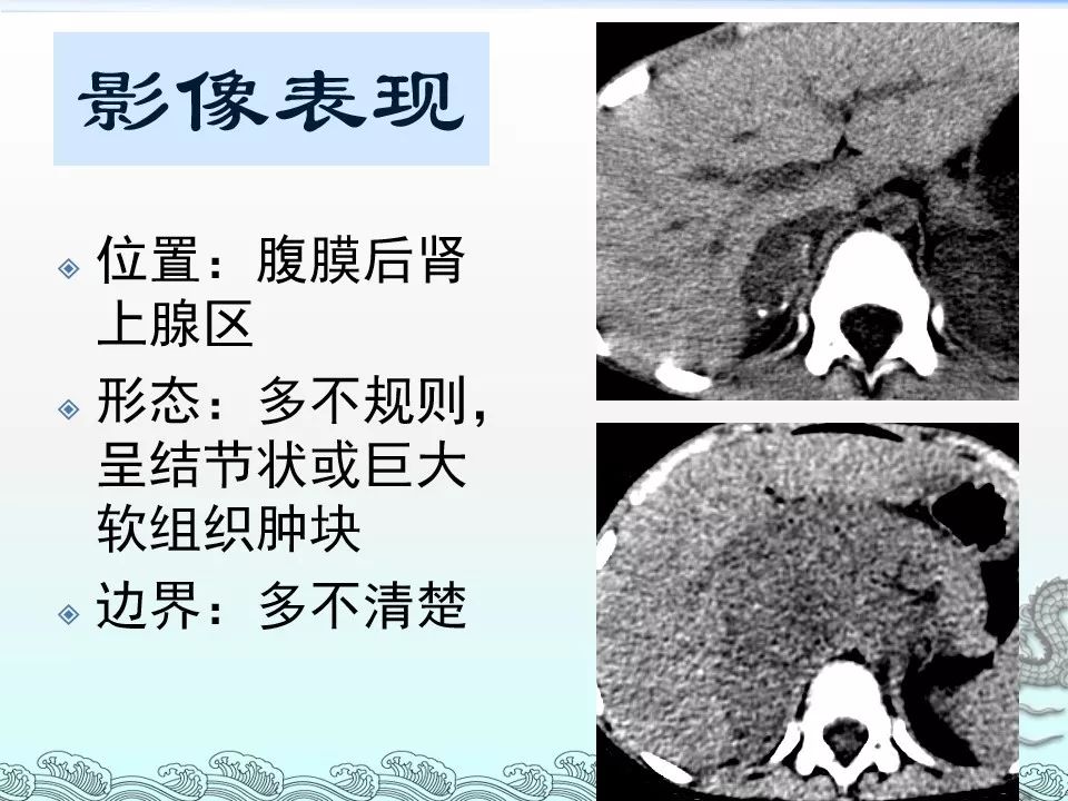 【PPT】肾上腺神经母细胞瘤影像诊断与鉴别诊断