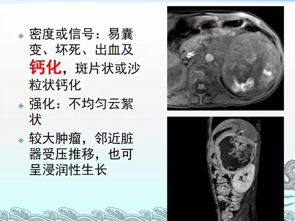 【PPT】肾上腺神经母细胞瘤影像诊断与鉴别诊断