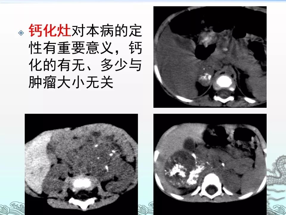 【PPT】肾上腺神经母细胞瘤影像诊断与鉴别诊断