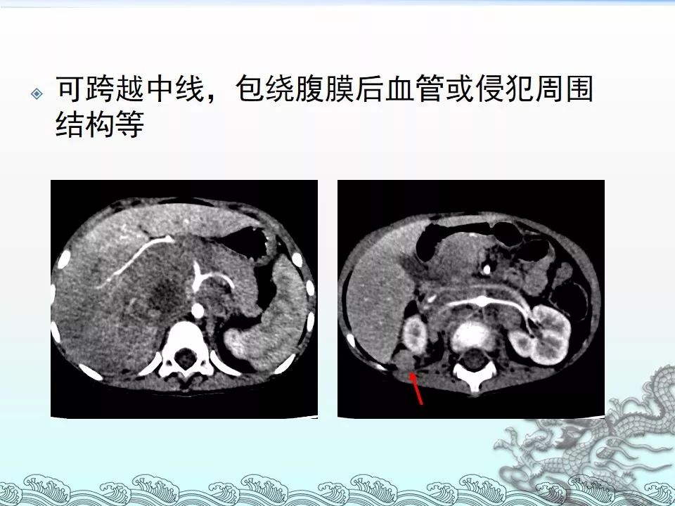 【PPT】肾上腺神经母细胞瘤影像诊断与鉴别诊断