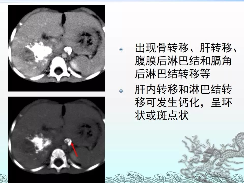 【PPT】肾上腺神经母细胞瘤影像诊断与鉴别诊断