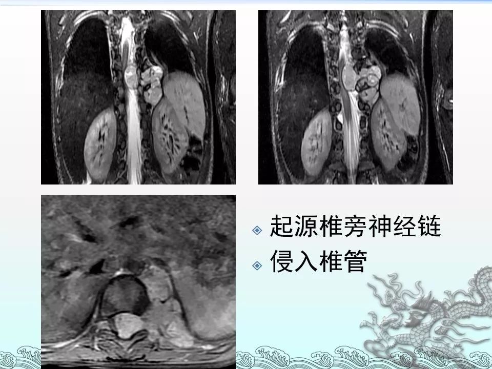 【PPT】肾上腺神经母细胞瘤影像诊断与鉴别诊断