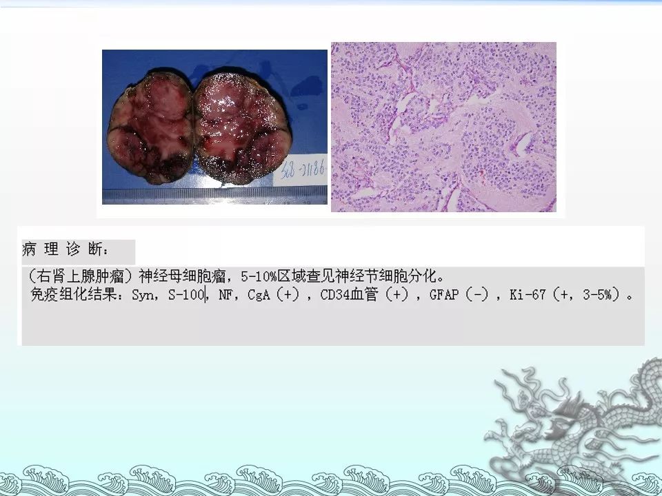 【PPT】肾上腺神经母细胞瘤影像诊断与鉴别诊断