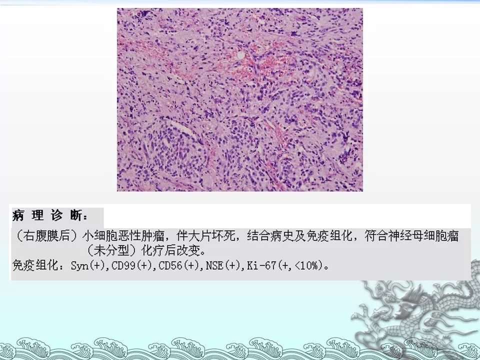 【PPT】肾上腺神经母细胞瘤影像诊断与鉴别诊断