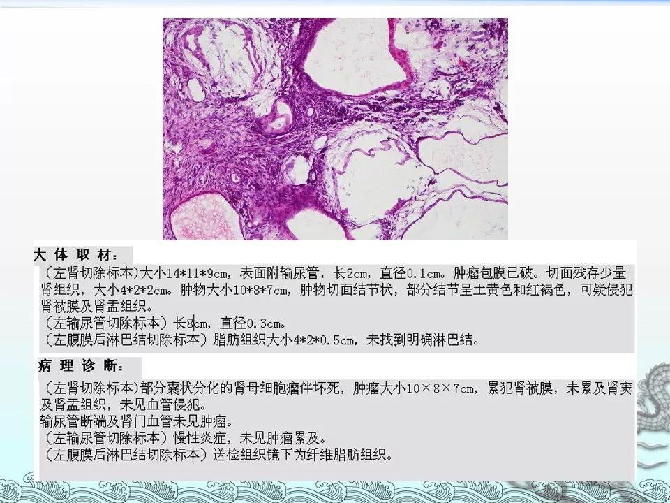 【PPT】肾上腺神经母细胞瘤影像诊断与鉴别诊断
