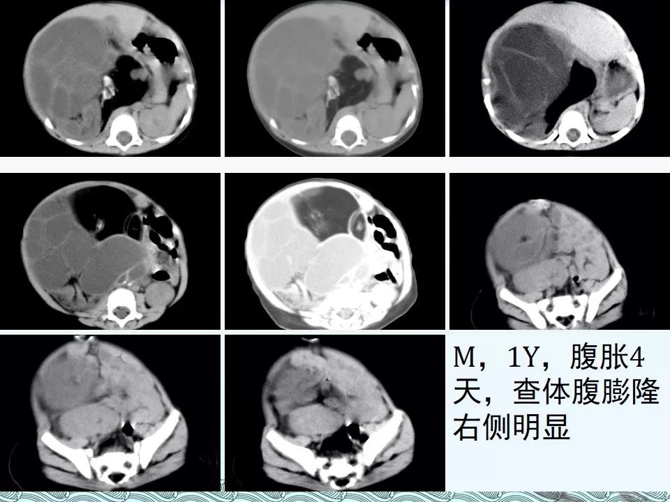【PPT】肾上腺神经母细胞瘤影像诊断与鉴别诊断
