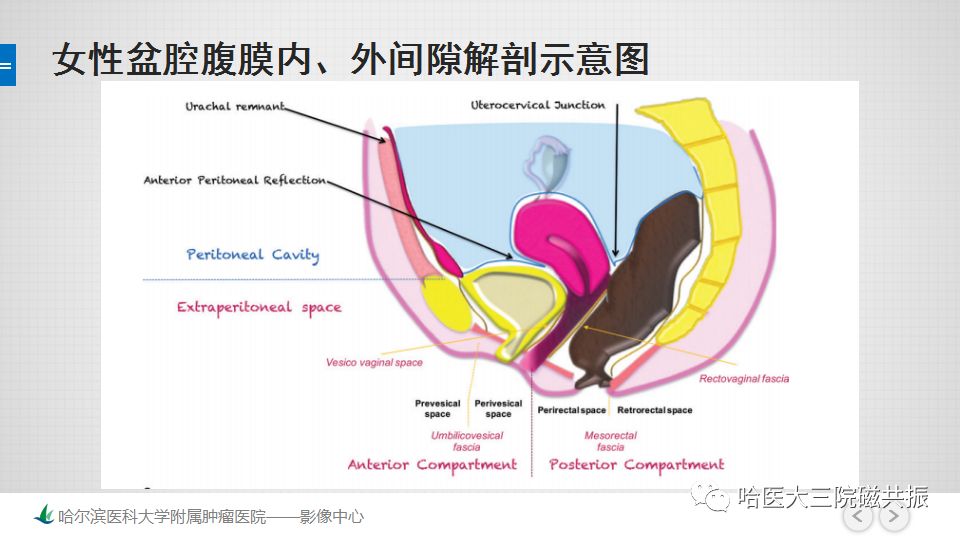 【PPT】女性盆腔肿瘤及肿瘤样变诊断思路分析—基于解剖位置