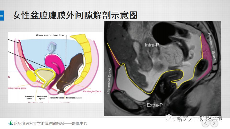 【PPT】女性盆腔肿瘤及肿瘤样变诊断思路分析—基于解剖位置