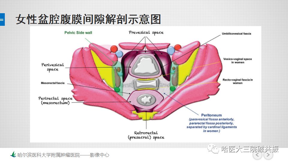 【PPT】女性盆腔肿瘤及肿瘤样变诊断思路分析—基于解剖位置