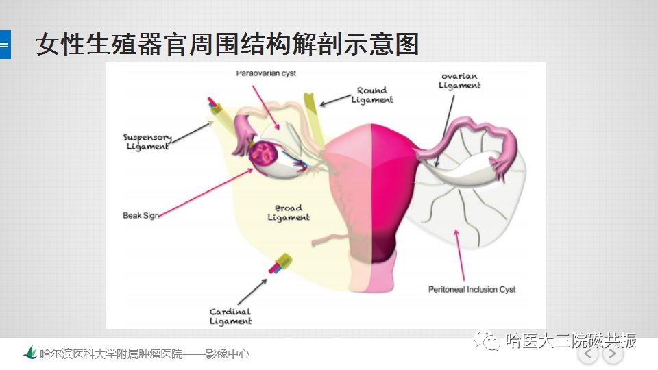 【PPT】女性盆腔肿瘤及肿瘤样变诊断思路分析—基于解剖位置
