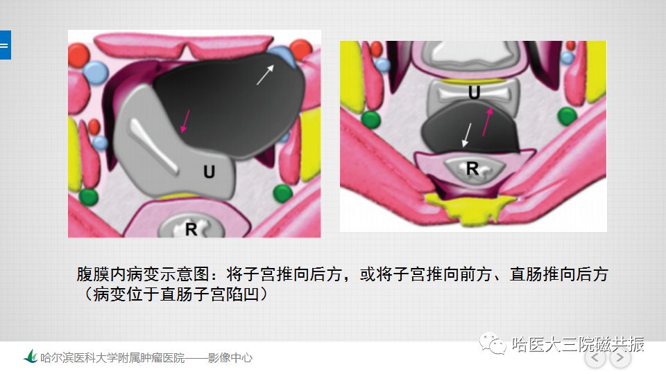 【PPT】女性盆腔肿瘤及肿瘤样变诊断思路分析—基于解剖位置