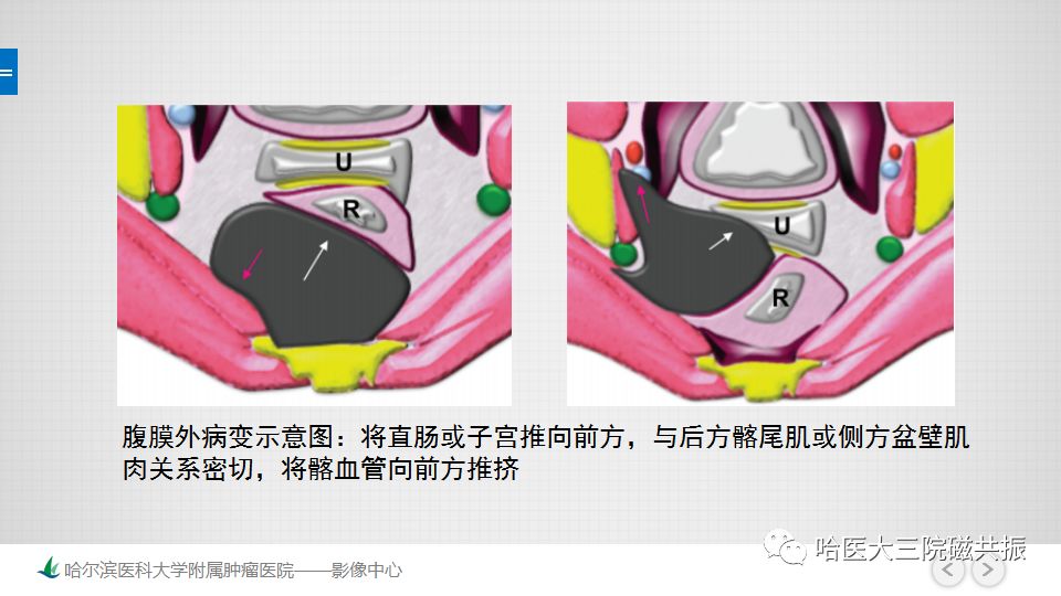 【PPT】女性盆腔肿瘤及肿瘤样变诊断思路分析—基于解剖位置