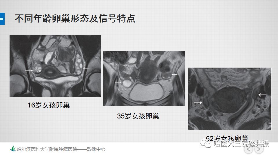 【PPT】女性盆腔肿瘤及肿瘤样变诊断思路分析—基于解剖位置
