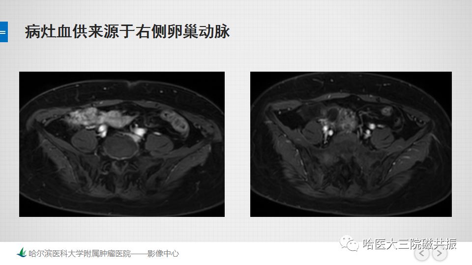 【PPT】女性盆腔肿瘤及肿瘤样变诊断思路分析—基于解剖位置