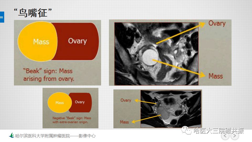 【PPT】女性盆腔肿瘤及肿瘤样变诊断思路分析—基于解剖位置