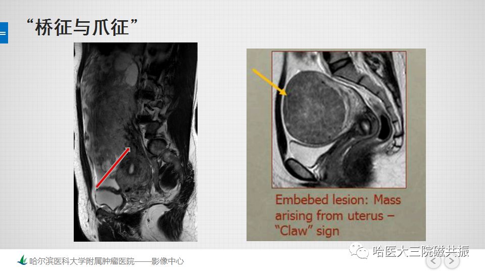 【PPT】女性盆腔肿瘤及肿瘤样变诊断思路分析—基于解剖位置