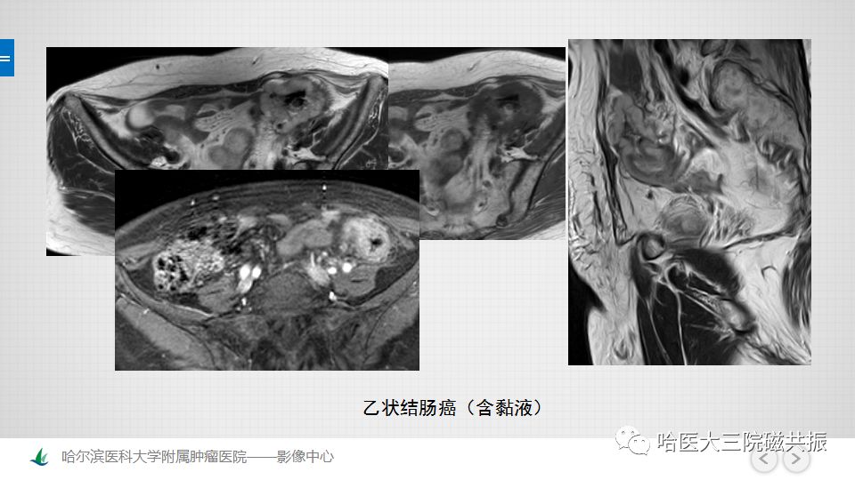 【PPT】女性盆腔肿瘤及肿瘤样变诊断思路分析—基于解剖位置