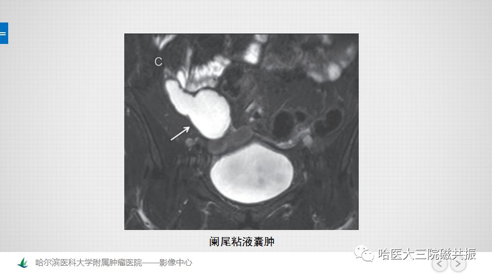 【PPT】女性盆腔肿瘤及肿瘤样变诊断思路分析—基于解剖位置