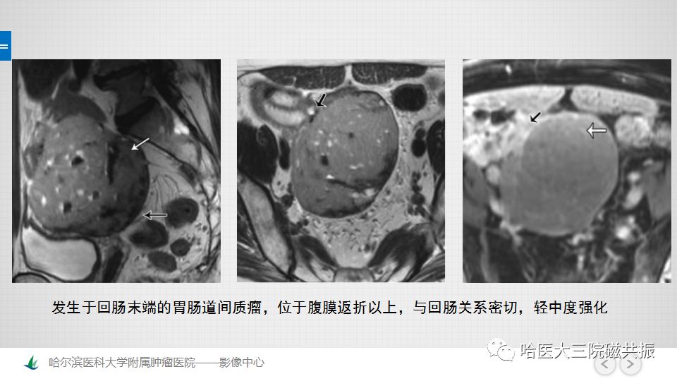 【PPT】女性盆腔肿瘤及肿瘤样变诊断思路分析—基于解剖位置