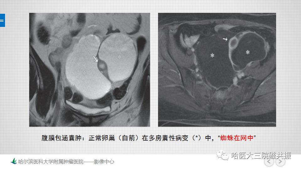 【PPT】女性盆腔肿瘤及肿瘤样变诊断思路分析—基于解剖位置