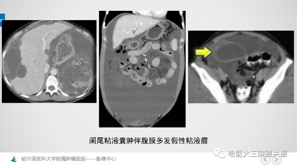 【PPT】女性盆腔肿瘤及肿瘤样变诊断思路分析—基于解剖位置
