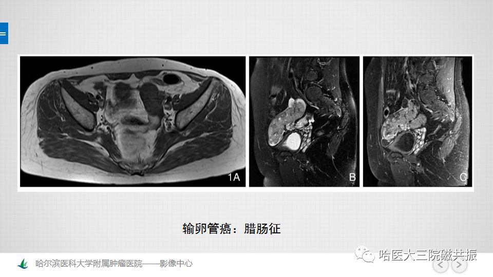 【PPT】女性盆腔肿瘤及肿瘤样变诊断思路分析—基于解剖位置