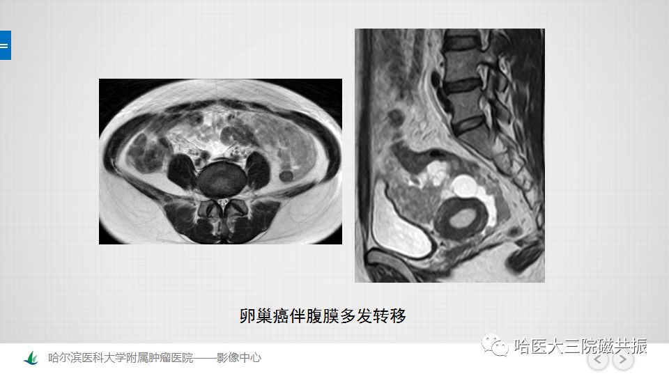 【PPT】女性盆腔肿瘤及肿瘤样变诊断思路分析—基于解剖位置