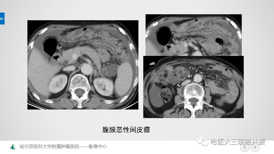 【PPT】女性盆腔肿瘤及肿瘤样变诊断思路分析—基于解剖位置