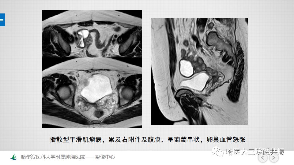 【PPT】女性盆腔肿瘤及肿瘤样变诊断思路分析—基于解剖位置
