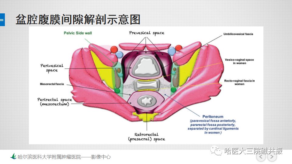 【PPT】女性盆腔肿瘤及肿瘤样变诊断思路分析—基于解剖位置