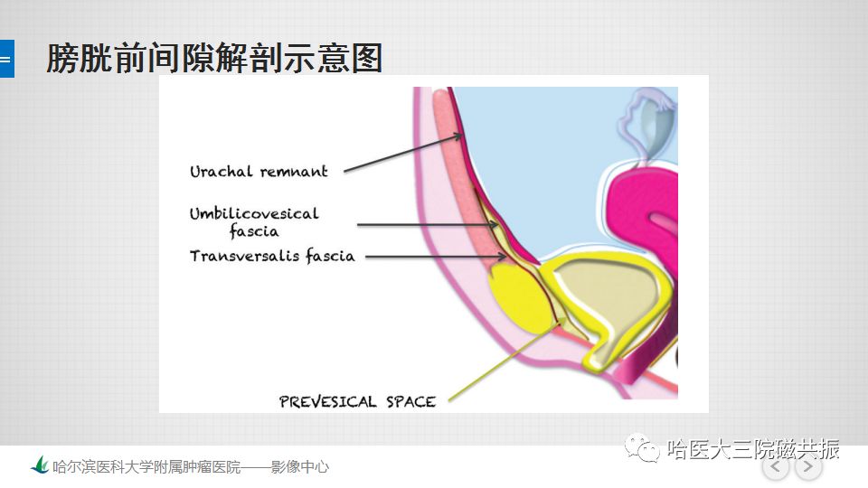 【PPT】女性盆腔肿瘤及肿瘤样变诊断思路分析—基于解剖位置